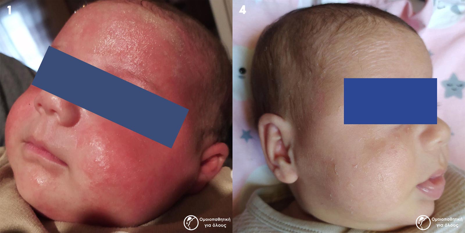 Ομοιοπαθητική & αποτελεσματικότητα σε αλλεργίες ή δυσανεξία τροφών σε μωρά